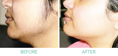 Laser Hair Removal Treatment Kochi | Laser Hair Removal Clinic Kerala