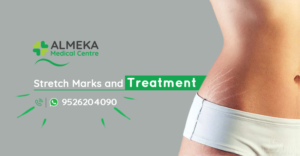 Stretch Marks and Treatment in Kochi