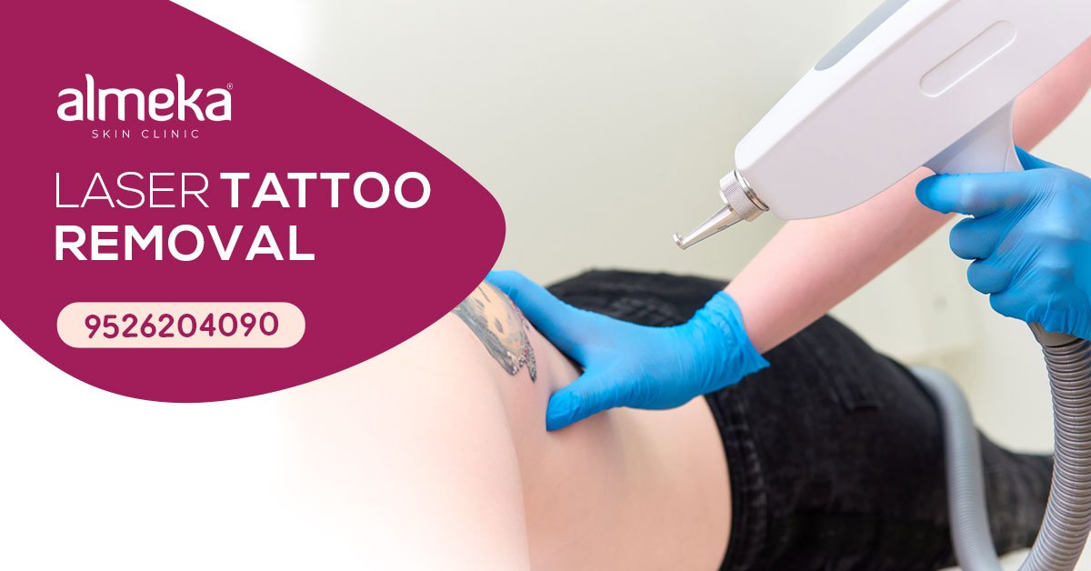 How many treatments are required to remove a tattoo  ppt download
