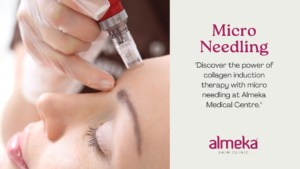 micro needling