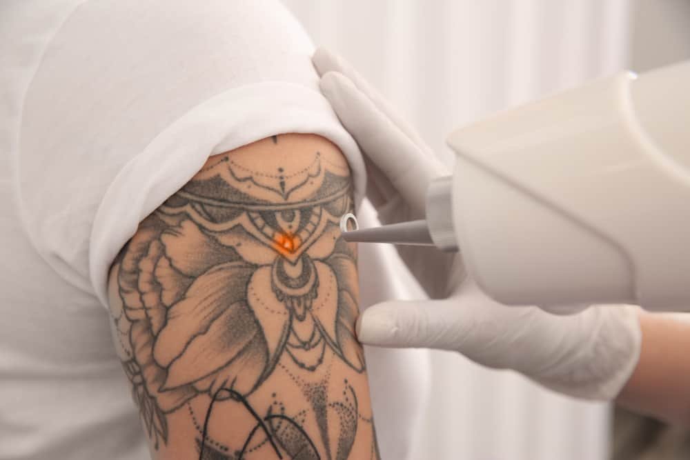 Laser Tattoo Removal Treatment at Skinaa Clinic | #shorts - YouTube