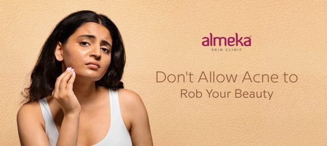 Almeka Ensures Lasting Beauty Despite Acne