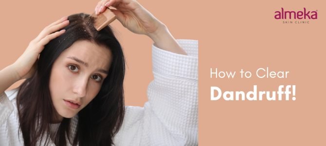 Advanced Treatments for Dandruff and Hair Loss