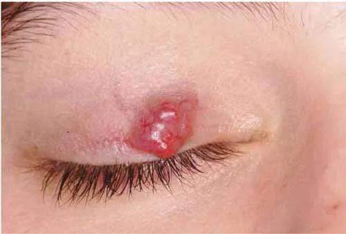 Capillary Haemangioma