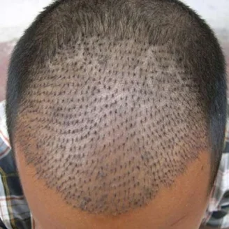 Hair Transplant