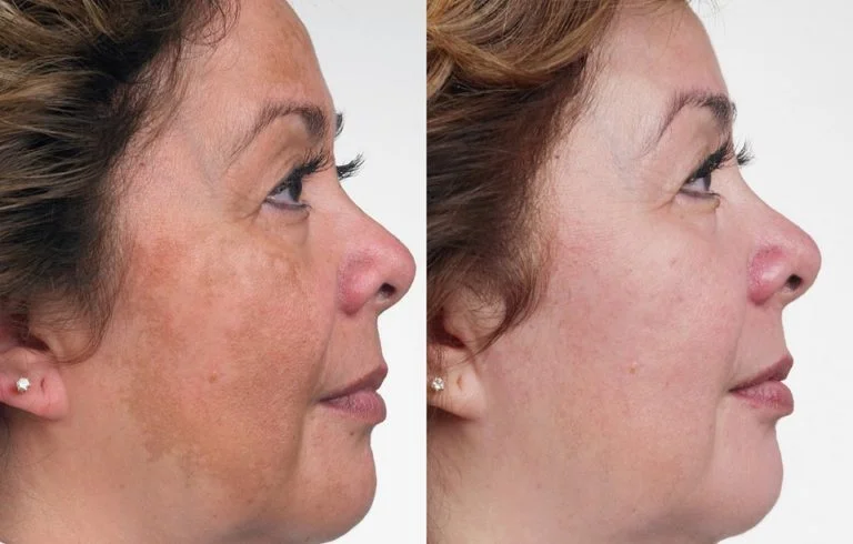 Melasma (Karymangalam)