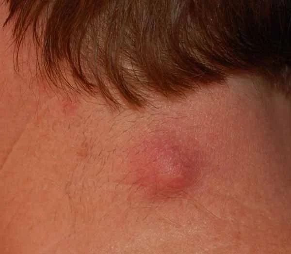 Sebaceous Cyst