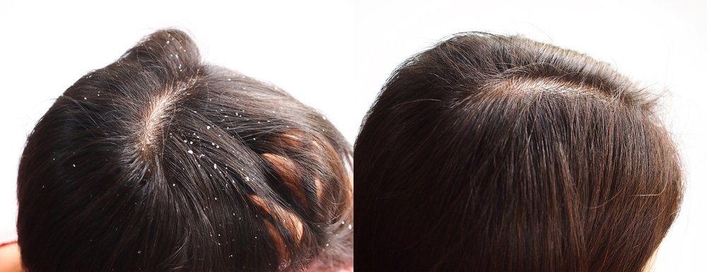 best hair loss treatment in Kerala