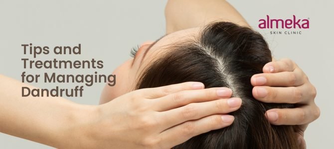 Effective Ways to Manage and Cure Dandruff