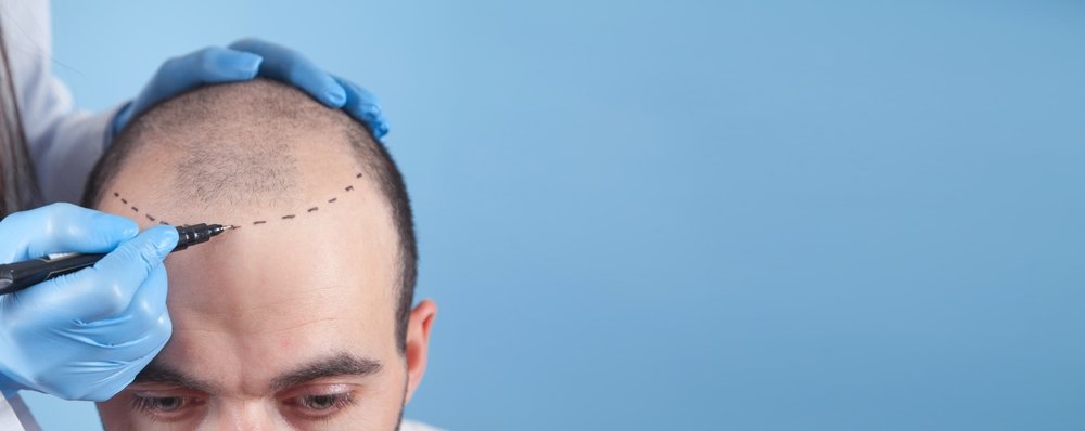 Best Hair Transplant In Kochi