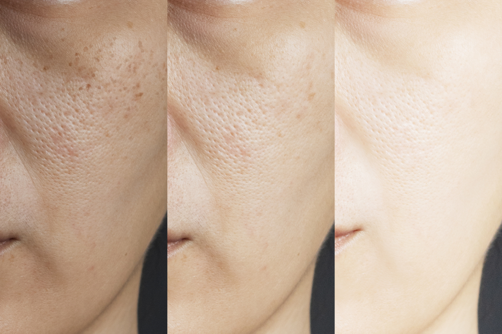 pigmentation treatment in Kochi 