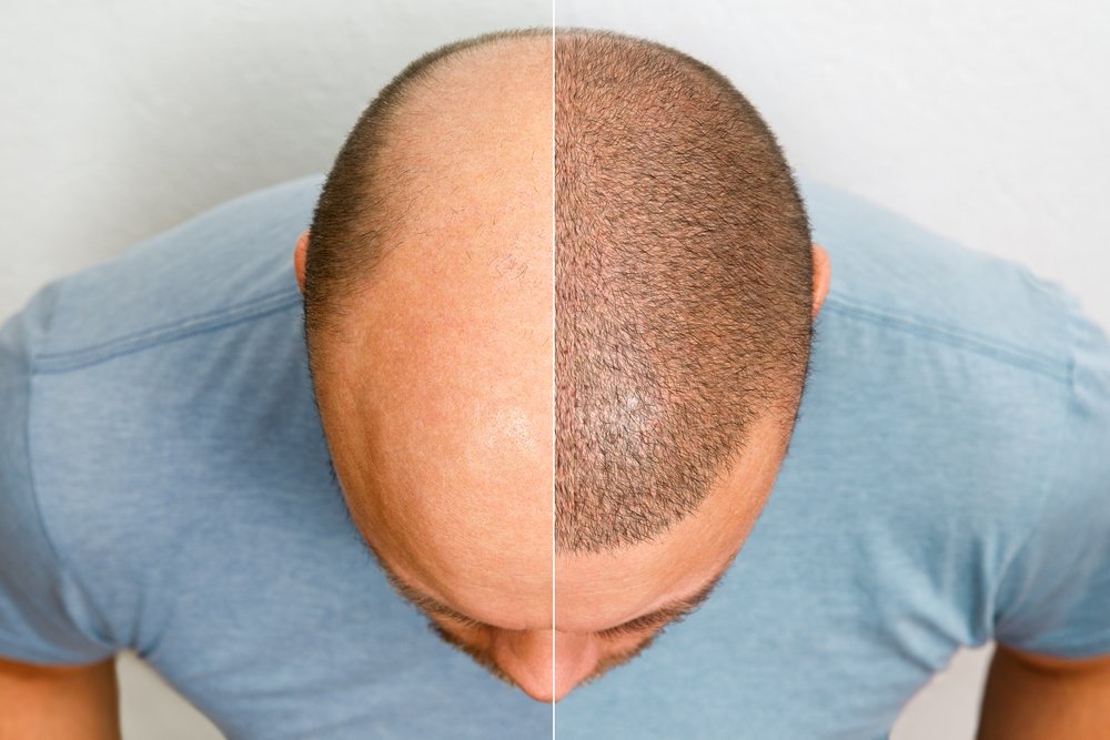 Best Hair Transplant Clinics in Kochi